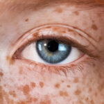 Tâches pigmentaires