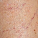 Télangiectasies / Varicosités