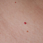 Tâches rubis / Lac veineux